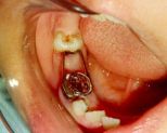 distal1.jpg