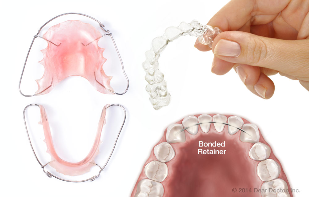 التقويم الشفاف (إنفيزالاين Invisalign)