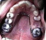 Palatal_holding_arch.jpg