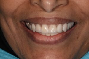 حالة تجميل أسنان وتأهيل كامل بالعدسات - إبتسامة هوليود