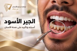 صورة توضح الجير الأسود المتراكم على الأسنان وأثره على صحة الأسنان -عيادات جذور الأسنان