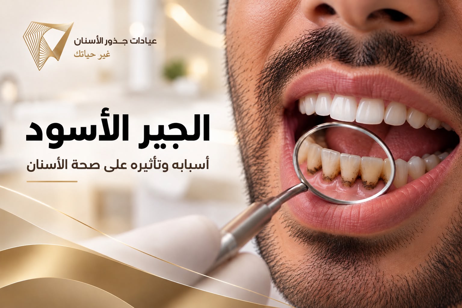 صورة توضح الجير الأسود المتراكم على الأسنان وأثره على صحة الأسنان -عيادات جذور الأسنان