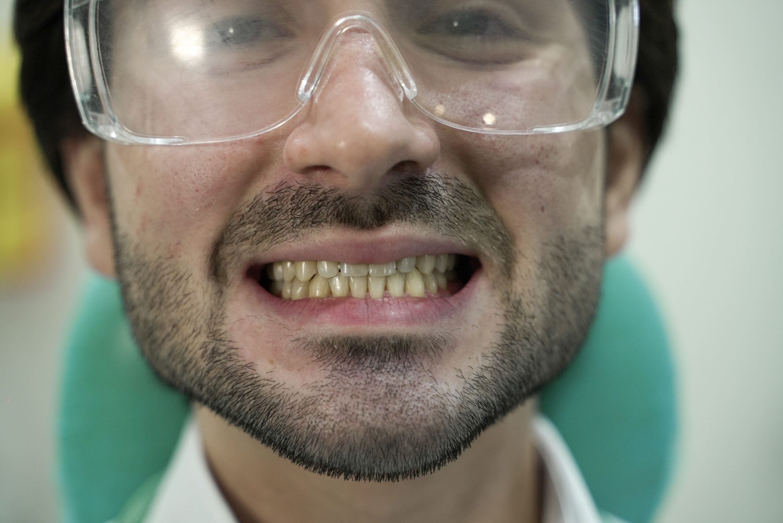 صورة ابتسامة قبل عمل تبييض الأسنان بجهاز الزووم الأمريكي | عيادات جذور الأسنان بجدة