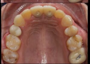 حالة تم علاجها زراعة الأسنان وتركيبات تجميليه فوق الزراعةدكتورة داليا نورة